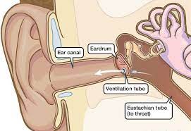 Ear tubes in Adults Pros and Cons