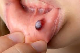 Sudden Blood Blister in Mouth