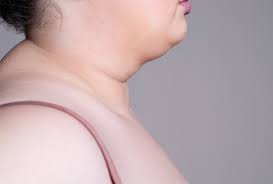 fat neck causes